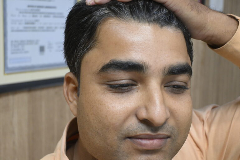 Successful Treatment of Verruca Plana (Flat Warts) – A Patient from Madhubani, Bihar