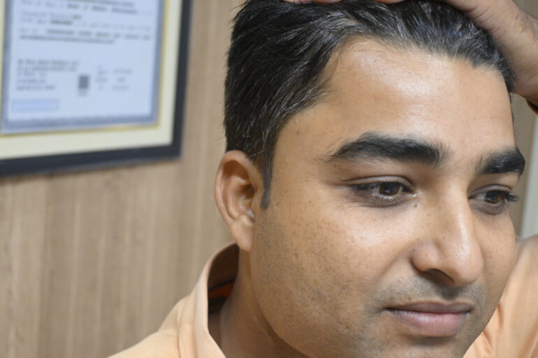 Successful Treatment of Verruca Plana (Flat Warts) – A Patient from Madhubani, Bihar