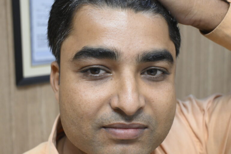 Successful Treatment of Verruca Plana (Flat Warts) – A Patient from Madhubani, Bihar