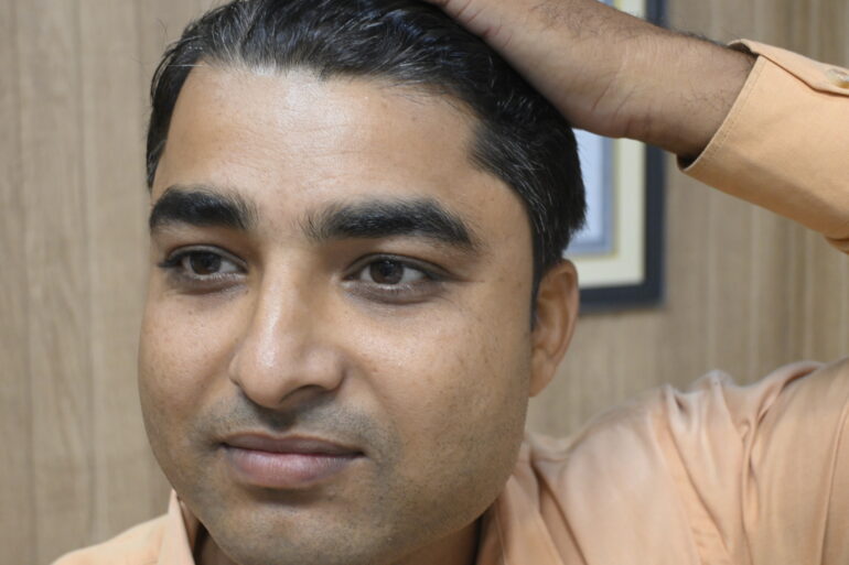 Successful Treatment of Verruca Plana (Flat Warts) – A Patient from Madhubani, Bihar