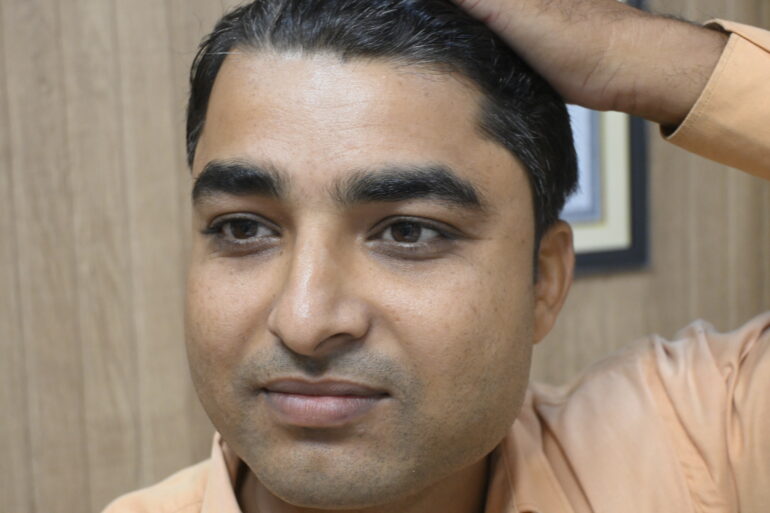 Successful Treatment of Verruca Plana (Flat Warts) – A Patient from Madhubani, Bihar