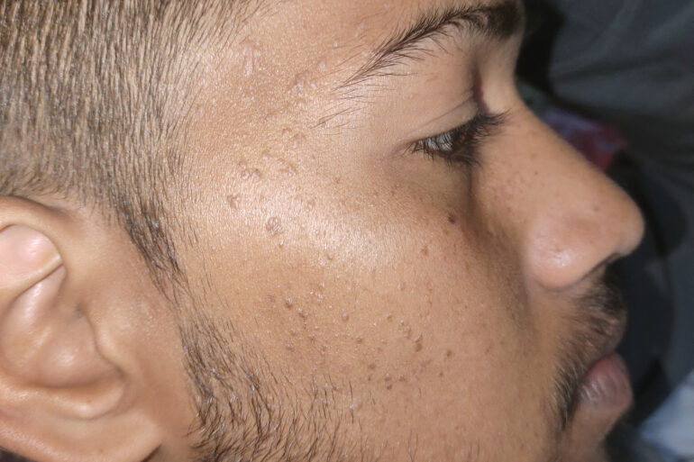Verruca Plana or Flat warts for 3 Years Got Cured in 4 Months