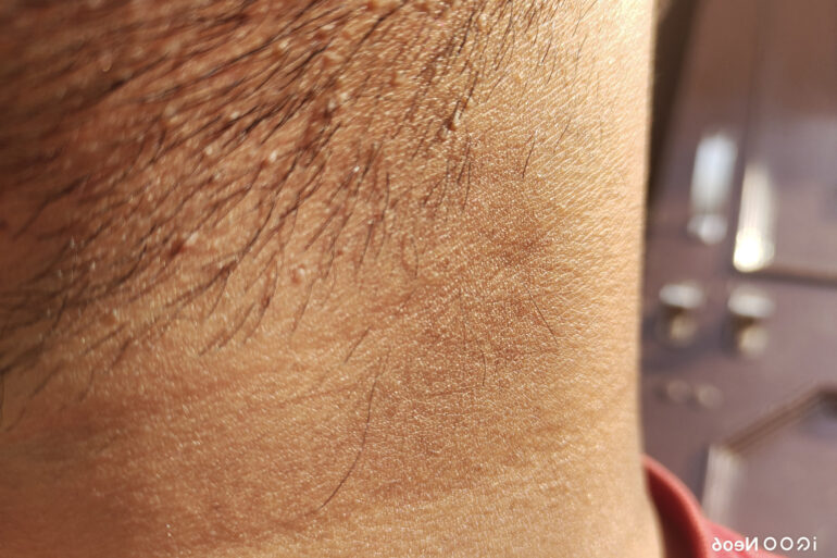 Verruca Plana or Flat warts for 3 Years Got Cured in 4 Months