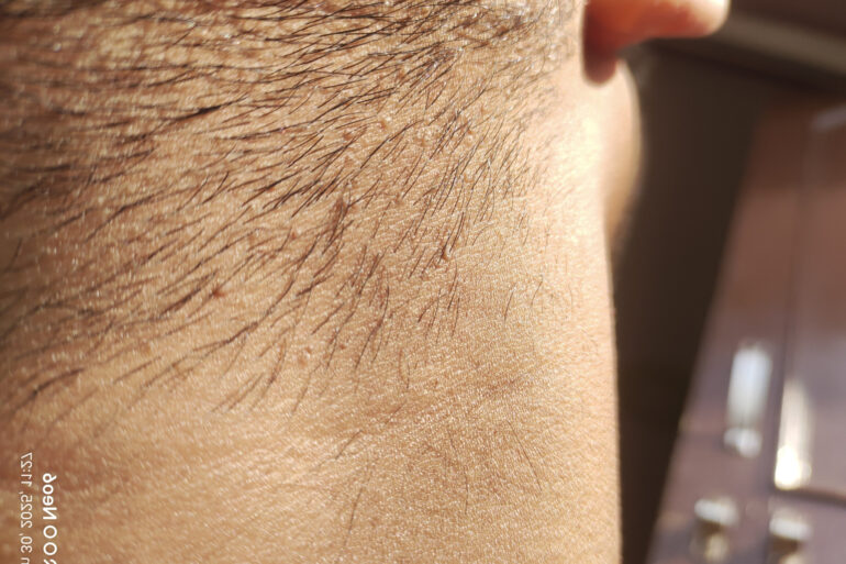 Verruca Plana or Flat warts for 3 Years Got Cured in 4 Months