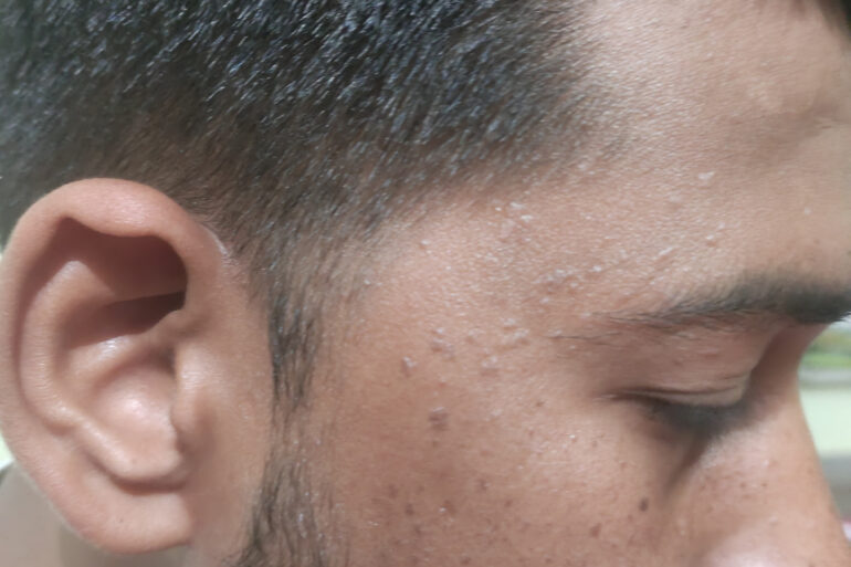 Verruca Plana or Flat warts for 3 Years Got Cured in 4 Months
