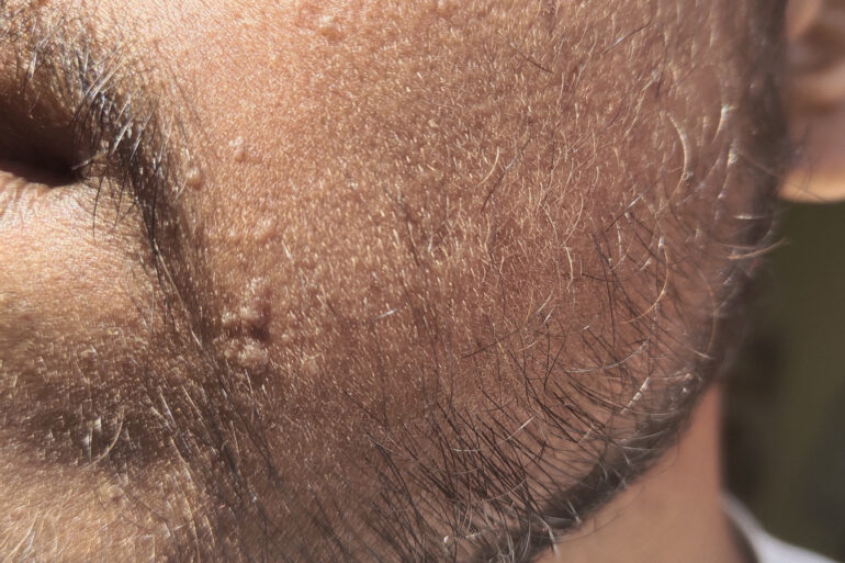 Verruca Plana or Flat warts for 3 Years Got Cured in 4 Months