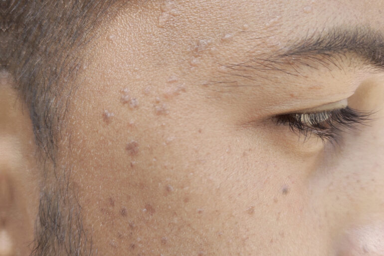 Verruca Plana or Flat warts for 3 Years Got Cured in 4 Months