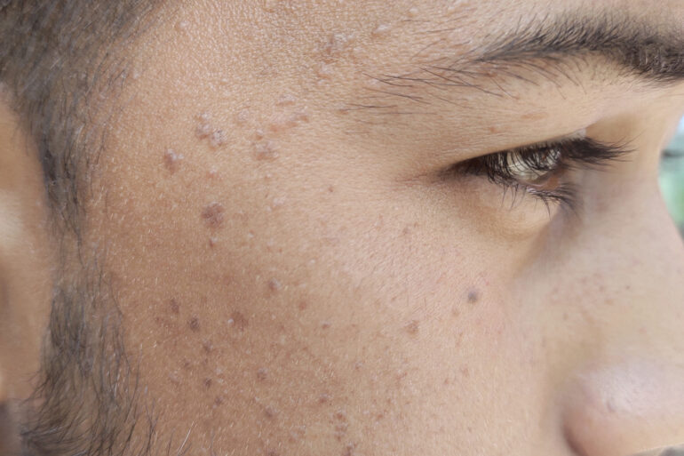 Verruca Plana or Flat warts for 3 Years Got Cured in 4 Months