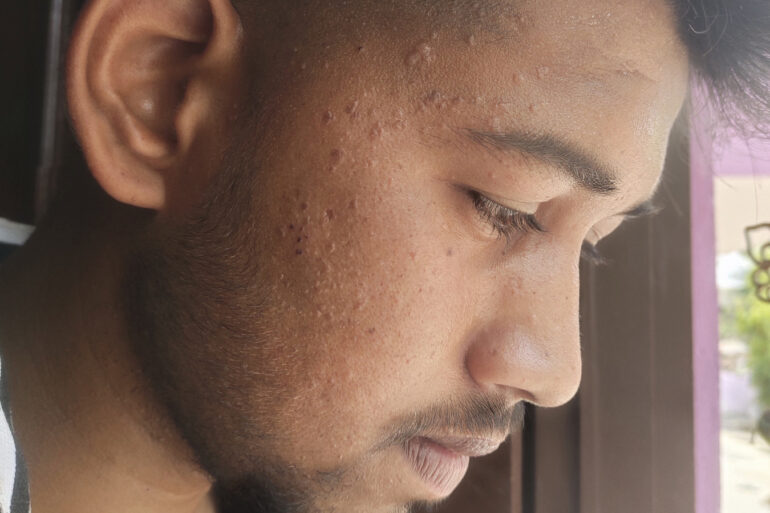 Verruca Plana or Flat warts for 3 Years Got Cured in 4 Months