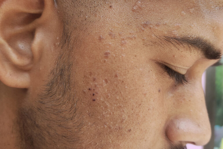 Verruca Plana or Flat warts for 3 Years Got Cured in 4 Months