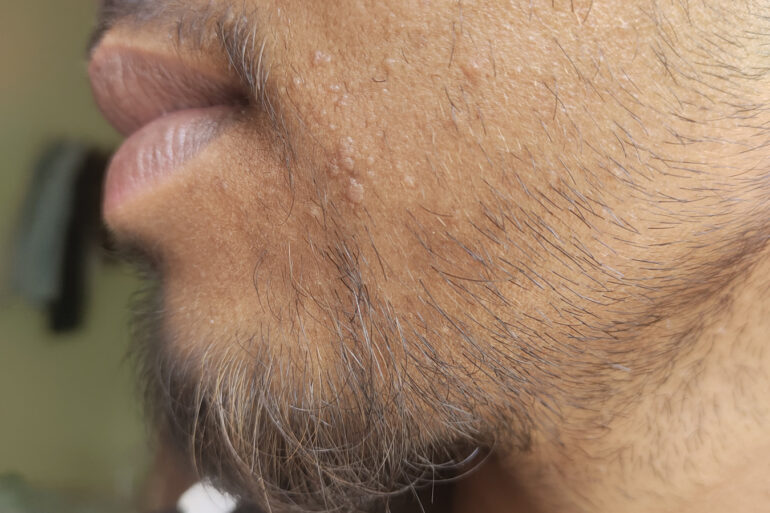 Verruca Plana or Flat warts for 3 Years Got Cured in 4 Months
