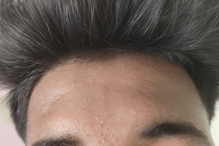 Verruca Plana or Flat warts for 3 Years Got Cured in 4 Months