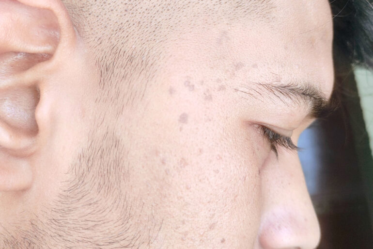 Verruca Plana or Flat warts for 3 Years Got Cured in 4 Months