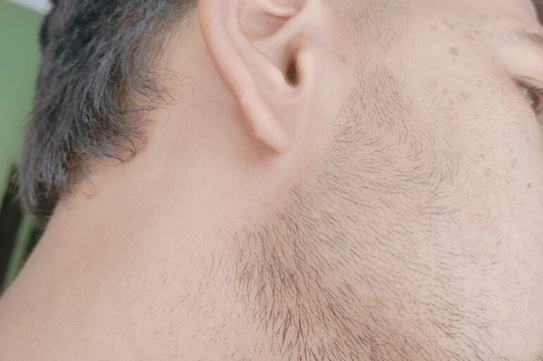 Verruca Plana or Flat warts for 3 Years Got Cured in 4 Months