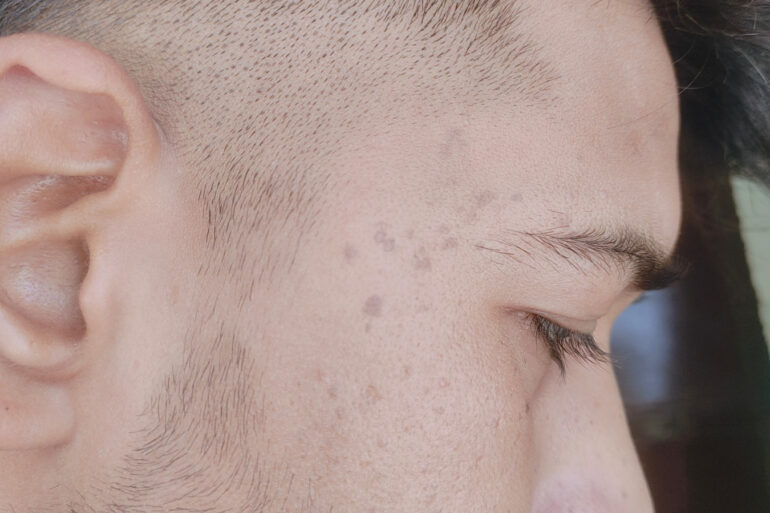 Verruca Plana or Flat warts for 3 Years Got Cured in 4 Months