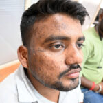 Successful Homeopathic Treatment of 4 Years long Flat Warts through Medicine Transmission
