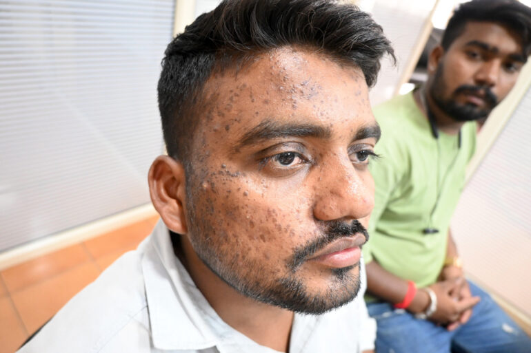 Successful Homeopathic Treatment of 4 Years long Flat Warts through Medicine Transmission