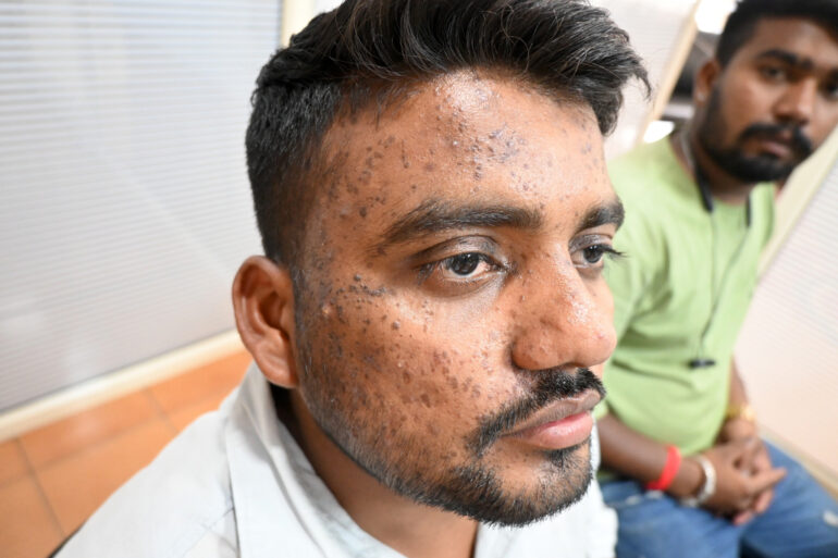 Successful Homeopathic Treatment of 4 Years long Flat Warts through Medicine Transmission