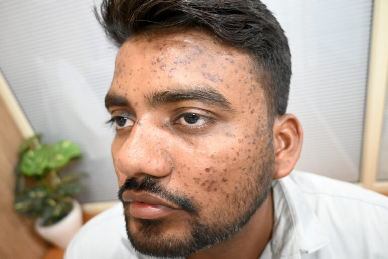 Successful Homeopathic Treatment of 4 Years long Flat Warts through Medicine Transmission