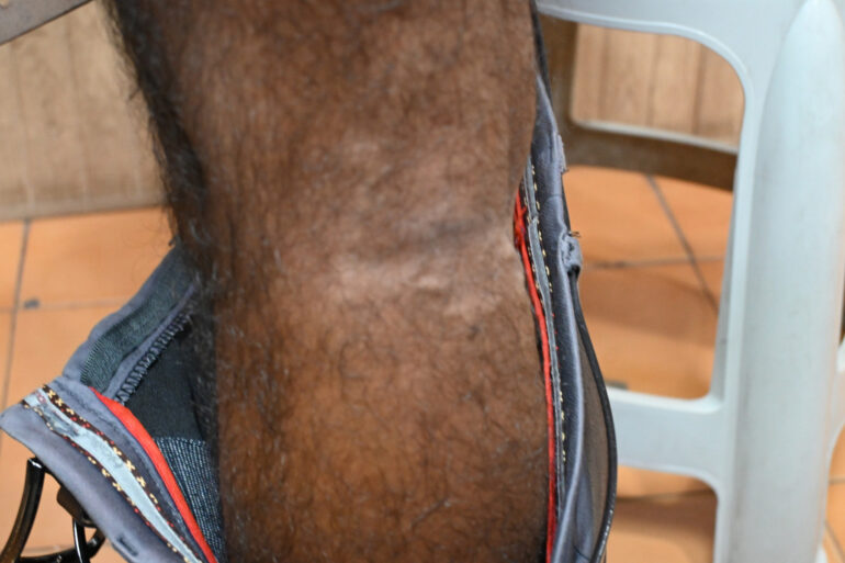 Successful Homeopathic Treatment of 4 Years long Flat Warts through Medicine Transmission