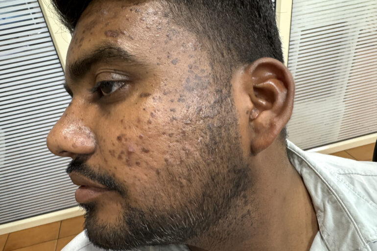 Successful Homeopathic Treatment of 4 Years long Flat Warts through Medicine Transmission