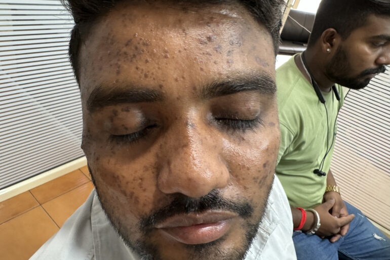 Successful Homeopathic Treatment of 4 Years long Flat Warts through Medicine Transmission