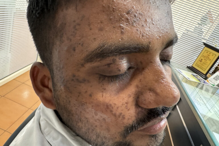 Successful Homeopathic Treatment of 4 Years long Flat Warts through Medicine Transmission