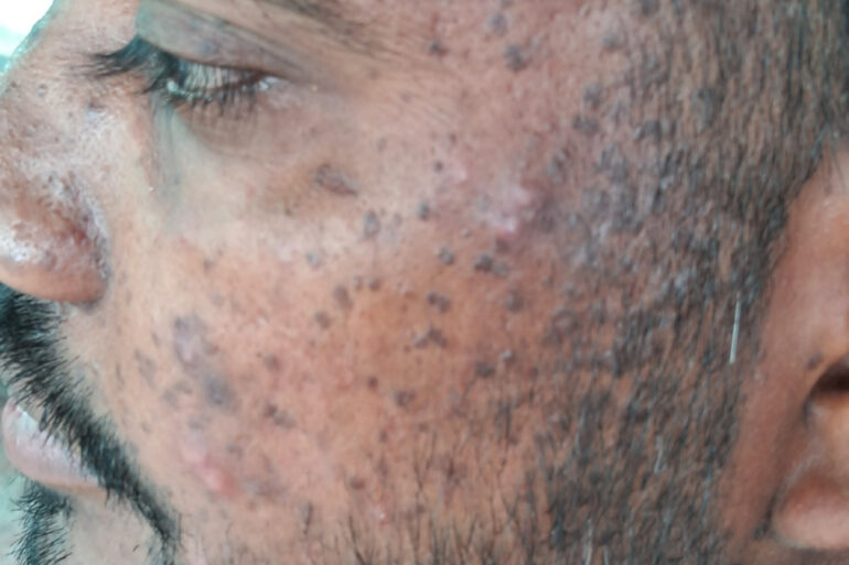 Successful Homeopathic Treatment of 4 Years long Flat Warts through Medicine Transmission