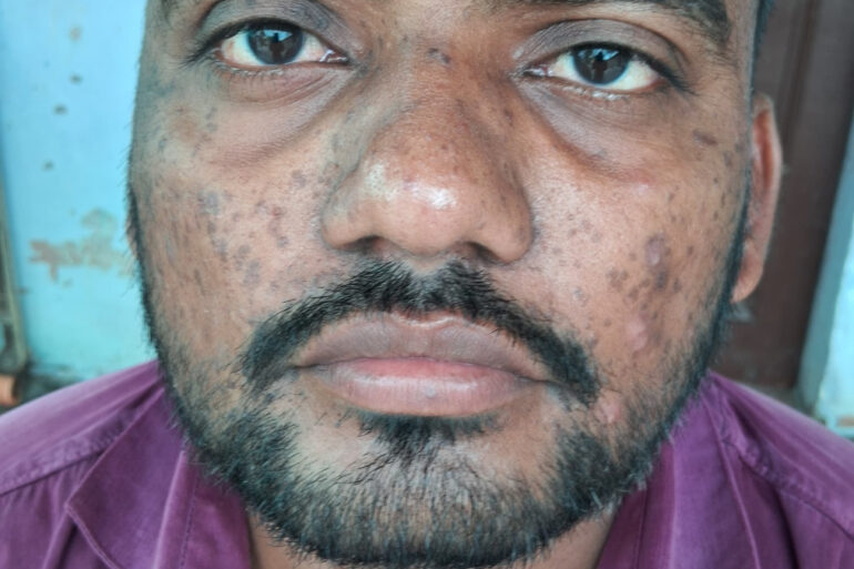 Successful Homeopathic Treatment of 4 Years long Flat Warts through Medicine Transmission