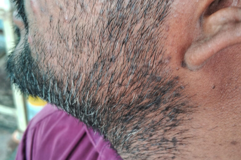 Successful Homeopathic Treatment of 4 Years long Flat Warts through Medicine Transmission