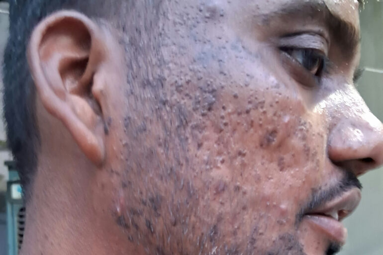 Successful Homeopathic Treatment of 4 Years long Flat Warts through Medicine Transmission