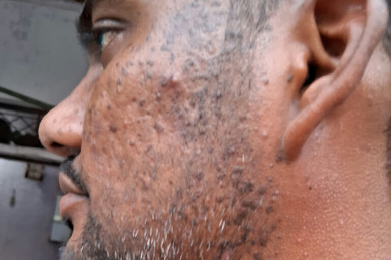 Successful Homeopathic Treatment of 4 Years long Flat Warts through Medicine Transmission