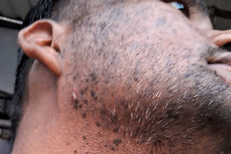 Successful Homeopathic Treatment of 4 Years long Flat Warts through Medicine Transmission