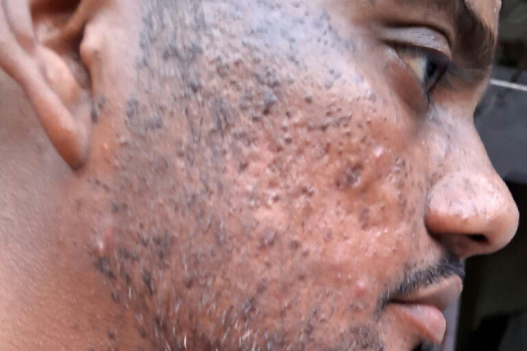 Successful Homeopathic Treatment of 4 Years long Flat Warts through Medicine Transmission