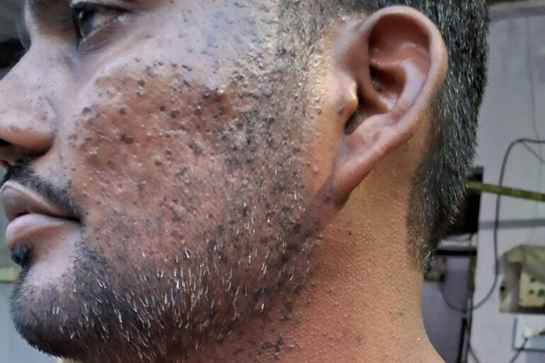 Successful Homeopathic Treatment of 4 Years long Flat Warts through Medicine Transmission