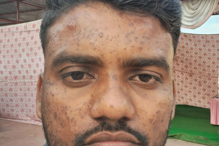 Successful Homeopathic Treatment of 4 Years long Flat Warts through Medicine Transmission