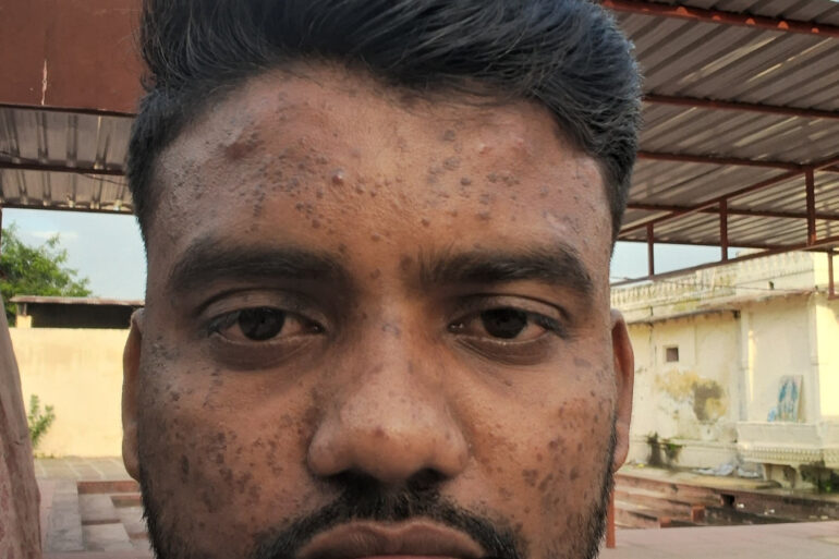 Successful Homeopathic Treatment of 4 Years long Flat Warts through Medicine Transmission