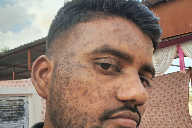 Successful Homeopathic Treatment of 4 Years long Flat Warts through Medicine Transmission