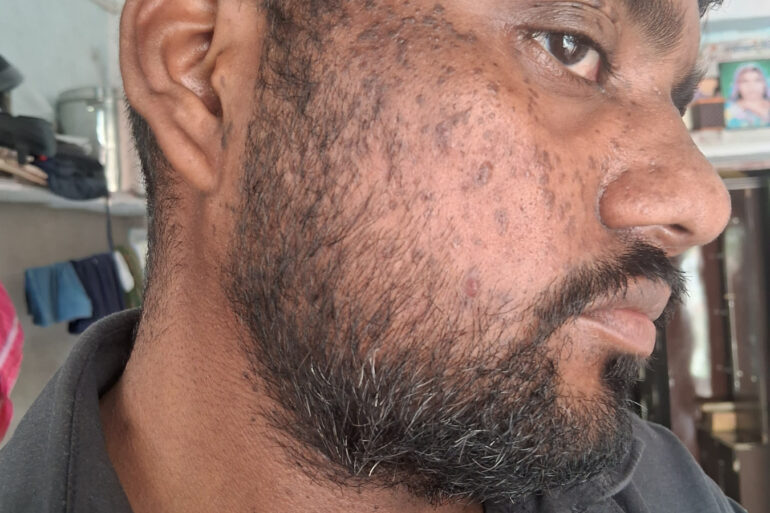 Successful Homeopathic Treatment of 4 Years long Flat Warts through Medicine Transmission