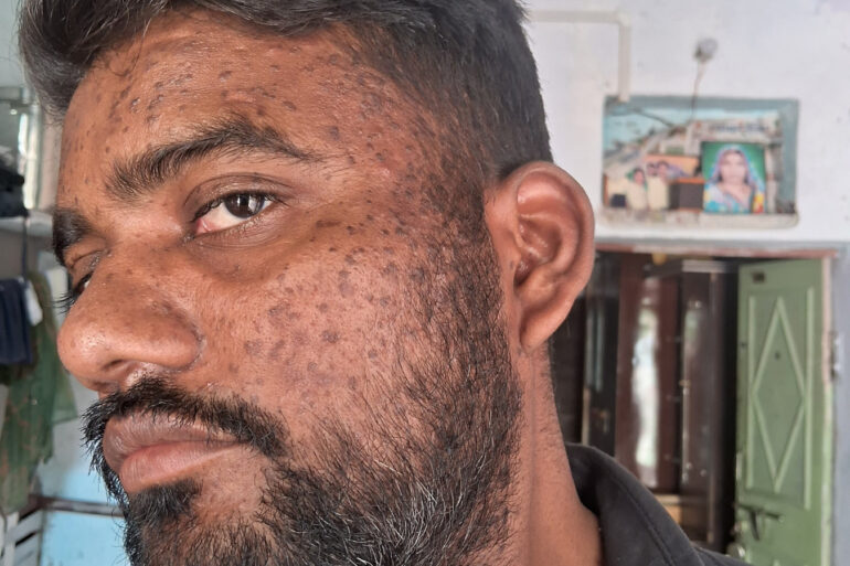 Successful Homeopathic Treatment of 4 Years long Flat Warts through Medicine Transmission