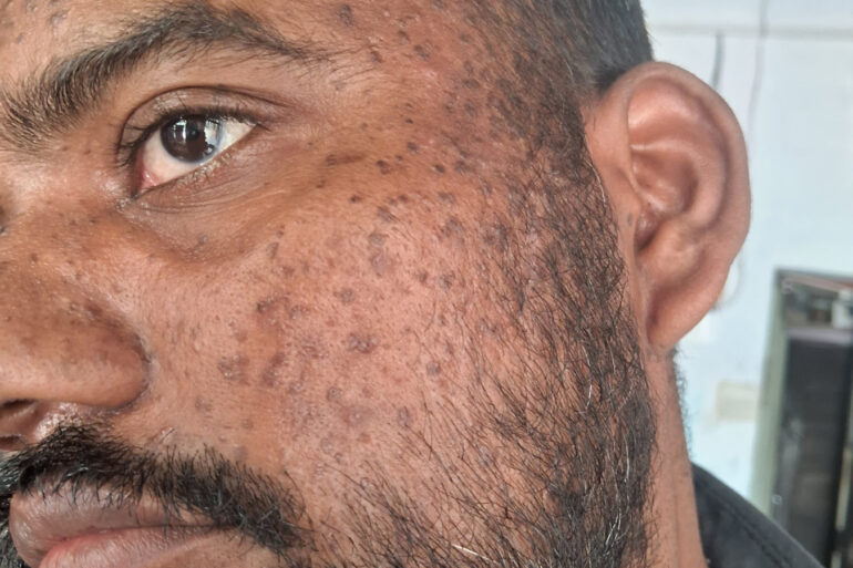 Successful Homeopathic Treatment of 4 Years long Flat Warts through Medicine Transmission