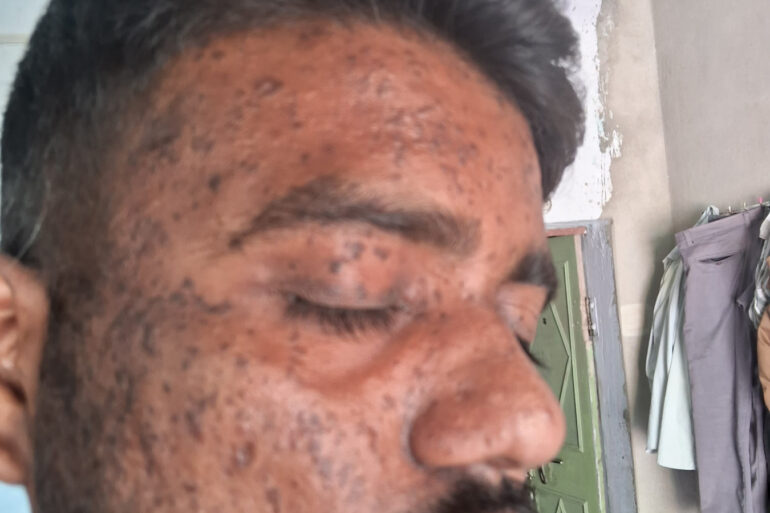 Successful Homeopathic Treatment of 4 Years long Flat Warts through Medicine Transmission