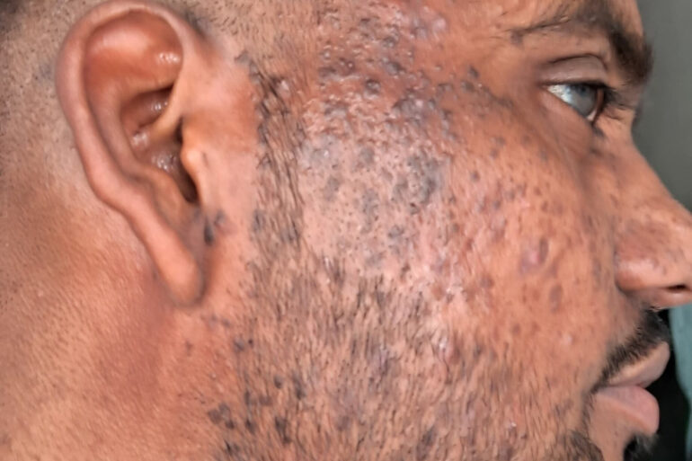 Successful Homeopathic Treatment of 4 Years long Flat Warts through Medicine Transmission