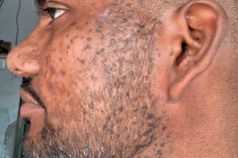 Successful Homeopathic Treatment of 4 Years long Flat Warts through Medicine Transmission