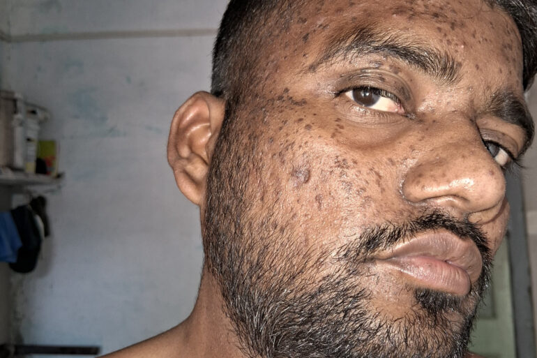 Successful Homeopathic Treatment of 4 Years long Flat Warts through Medicine Transmission