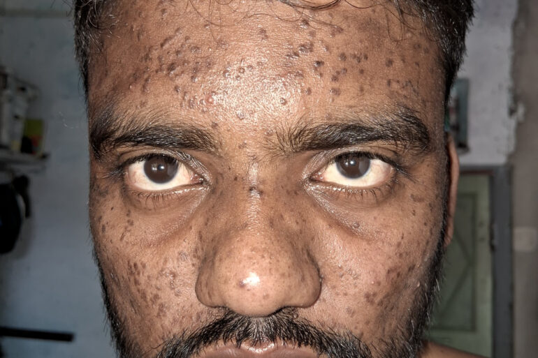 Successful Homeopathic Treatment of 4 Years long Flat Warts through Medicine Transmission