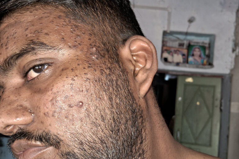 Successful Homeopathic Treatment of 4 Years long Flat Warts through Medicine Transmission