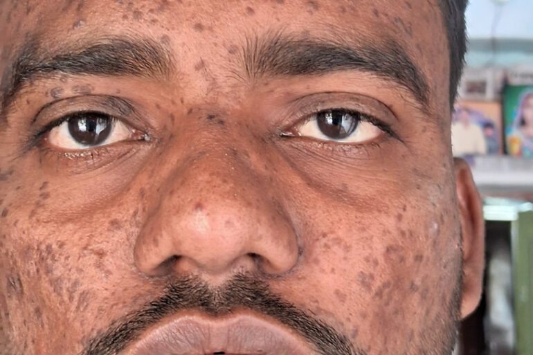 Successful Homeopathic Treatment of 4 Years long Flat Warts through Medicine Transmission