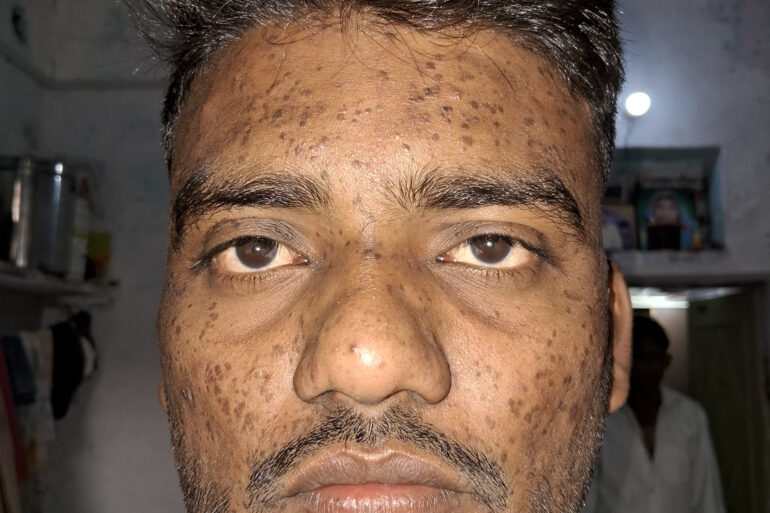 Successful Homeopathic Treatment of 4 Years long Flat Warts through Medicine Transmission