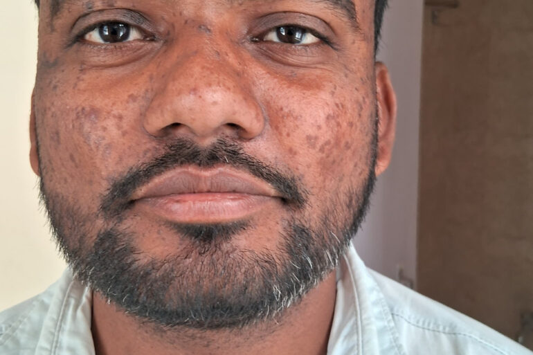 Successful Homeopathic Treatment of 4 Years long Flat Warts through Medicine Transmission